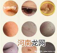 hpv有什么表现症状女性感染 HPV有什么表现症状