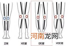 罗圈腿怎么矫正 罗圈腿图片症状及矫正方法