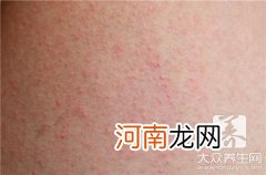 面部湿疹的最佳治疗方法是什么？ 面部湿疹怎么治