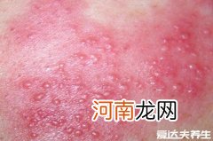 水痘早期图片大全小孩红斑 水痘早期图片大全