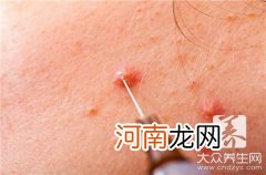 甲状腺结节保守治疗方法 甲状腺恶性结节能保守治疗吗