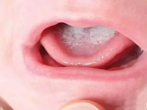 婴儿鹅口疮最早期图片 症状 婴儿鹅口疮最早期图片