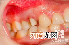牙龈出血是什么病征兆 牙龈无缘无故出血是什么病的症状