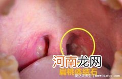 吐出扁桃体结石怎么治疗 4个吐出扁桃体结石小妙招