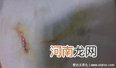 女性感染hpv是什么病毒图片