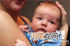 幼儿面部湿疹怎样治疗？ 幼儿面部湿疹的症状及治疗方法