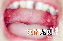 口腔溃疡是缺乏哪种维生素 口腔溃疡体内缺什么维生素