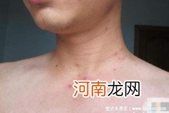 淋巴结肿大 男性艾滋病的10个征兆