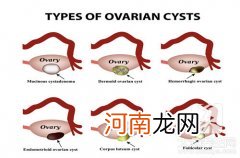 宫颈囊肿图片和治疗 宫颈上有囊肿需要治疗吗图片