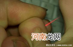 怎样判断是不是鸡眼图