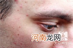 男孩青春期长痘痘怎么办 青春期男生满脸痘痘怎么办