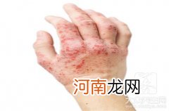 季节性湿疹是什么原因 湿疹常发的季节