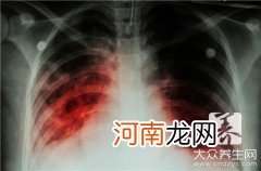 结核杆菌抗体阳性防治原则 结核杆菌抗体阳性怎么治疗