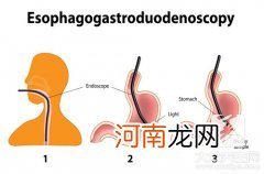 消化道肿瘤6项 消化道肿瘤6项正常值多少