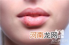 疱疹容易传染吗？ 疱疹传染人不