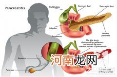 胆结石怎么治疗最有效 如何治疗胆结石更有效