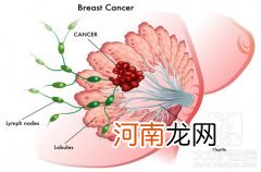 治疗乳腺增生八个偏方 治疗乳腺增生的民间偏方