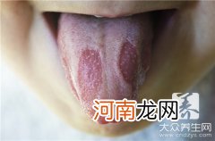 舌头上有苔藓 舌头有苔藓是怎么回事