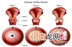 人乳头瘤病毒33型阳性是什么意思 人乳头瘤病毒33型阳性是什么意思女