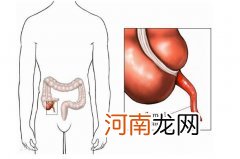 阑尾具体位置在哪儿图 阑尾在哪个位置图解