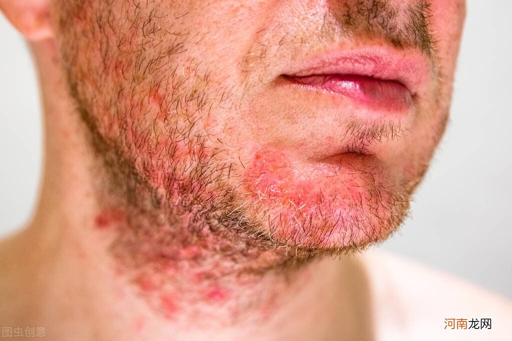 皮肤微生态是什么？皮肤不好还会“传染”给别人？