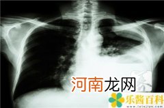 肺癌晚期死前半个月征兆  肺癌晚期死前6个月征兆