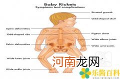 钩端螺旋体三症状三体征 钩体病的三症状三体征？