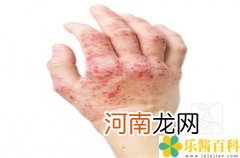 皮癣和湿疹的区别,外在特征是什么样 皮癣和湿疹的区别