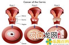 肺原位癌是什么意思,能治愈吗  原位癌是什么意思