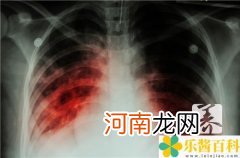 肺上有病变有哪些可能 肺癌初期有什么症状