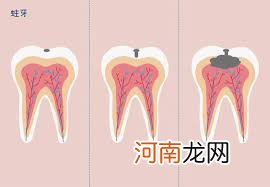 治蛀牙的中医偏方有哪些