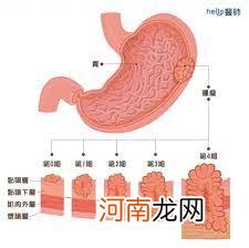 全球一半胃癌患者在中国！提醒：常吃“这4种”食物的人，要小心