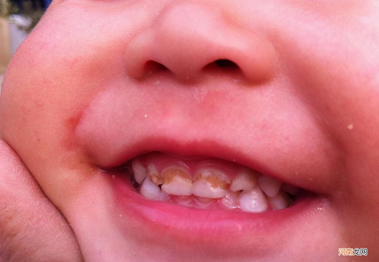 乳牙迟早要换，变成龋齿也无所谓？这两大危害，家长可别不当回事