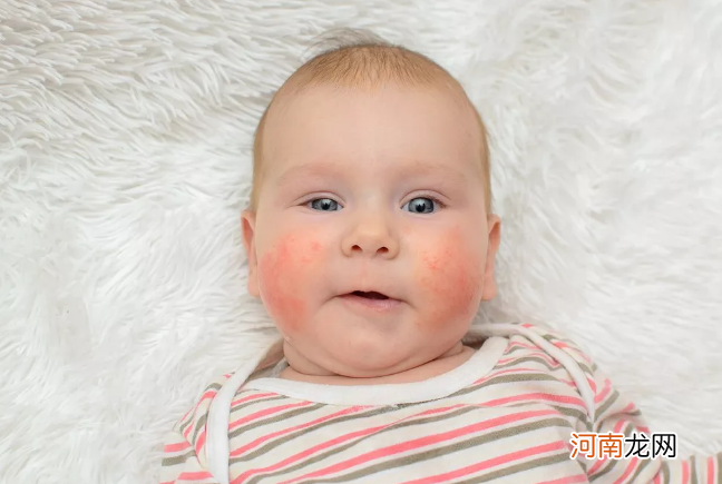 宝宝皮肤干燥,发红发痒,有湿疹怎么办?儿科医生教你这样护理