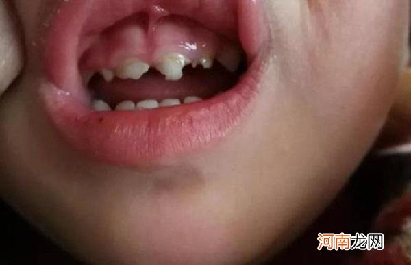 孩子乳牙被蛀，这三个后果可不轻，及时就医很关键，家长别再拖了