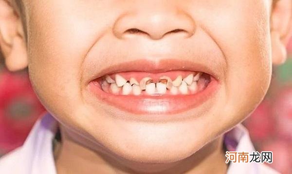 孩子乳牙被蛀，这三个后果可不轻，及时就医很关键，家长别再拖了