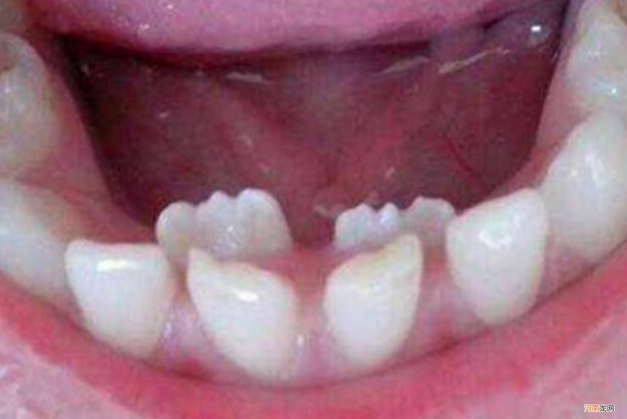 7岁男孩长“双排牙”，原因是妈妈的精细喂养，换牙期宝宝要注意