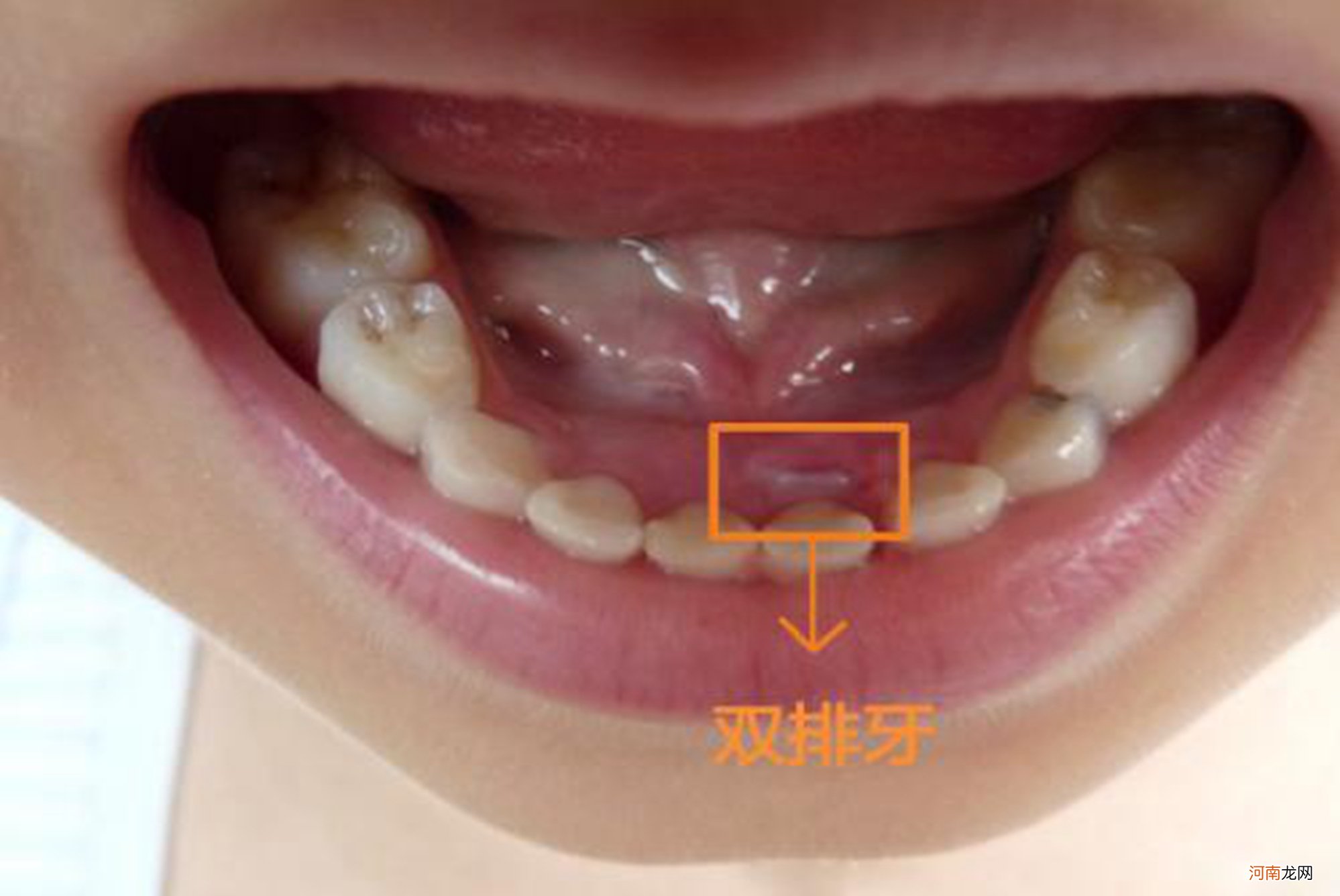 7岁男孩长“双排牙”，原因是妈妈的精细喂养，换牙期宝宝要注意