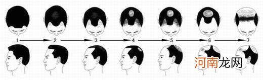 如何区分正常掉发和脱发 怎样鉴定自己在脱发