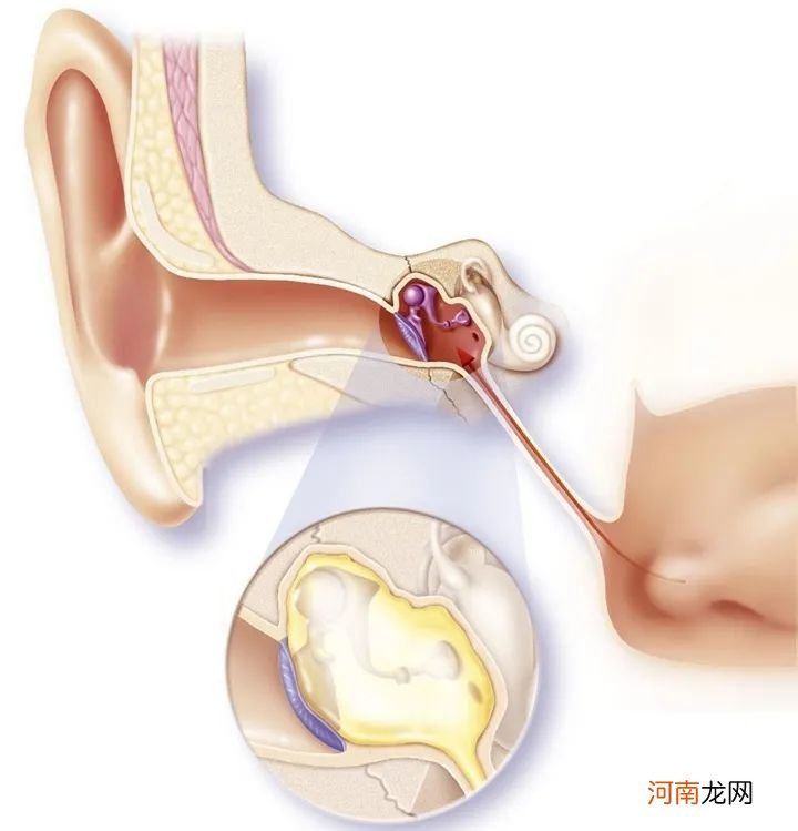 孩子感冒发烧后，为什么容易得中耳炎？