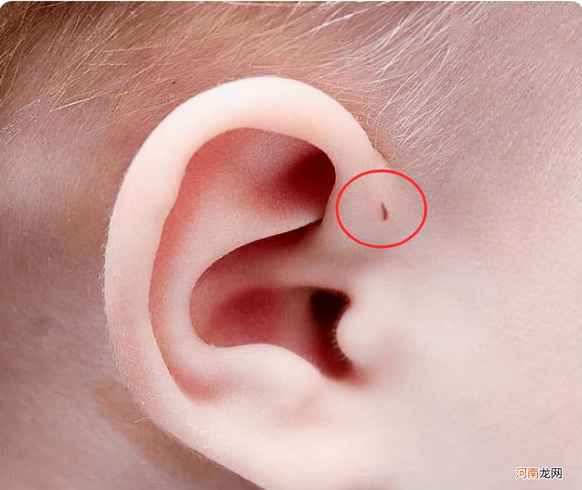 为什么有些孩子耳朵会有“小孔”？医生一般不说，父母心里要有数
