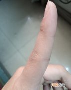 你的左手食指有一道疤吗 为什么每个人的左手食指有一个疤