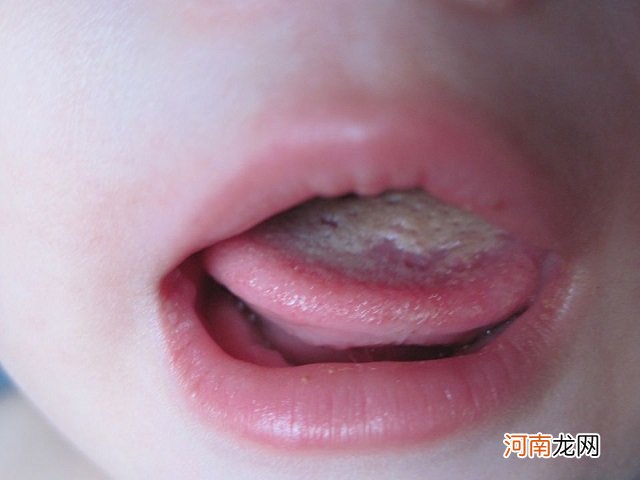 孩子感冒、胀气老不好？多半是积食了，对照这些症状看娃占了几个