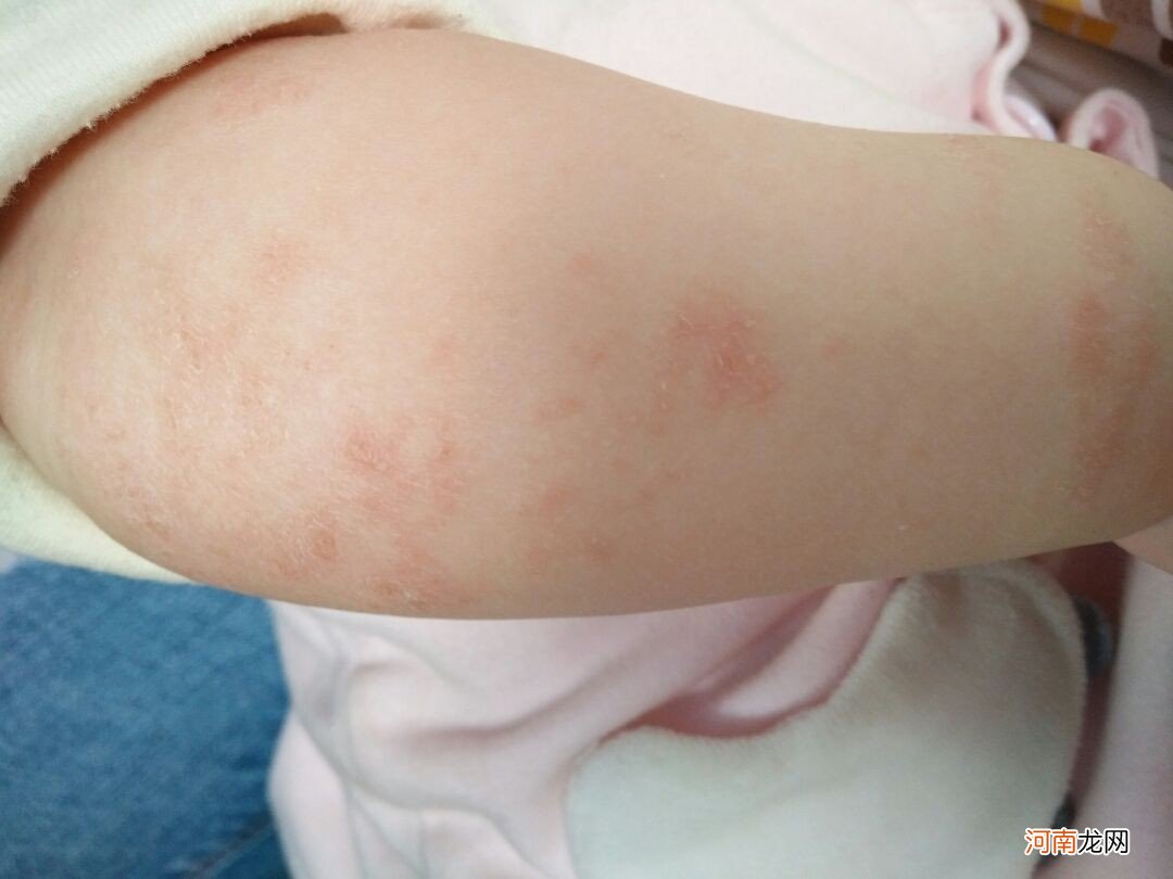 宝宝湿疹是什么样的疑难杂症？为什么困扰了这么多的宝妈
