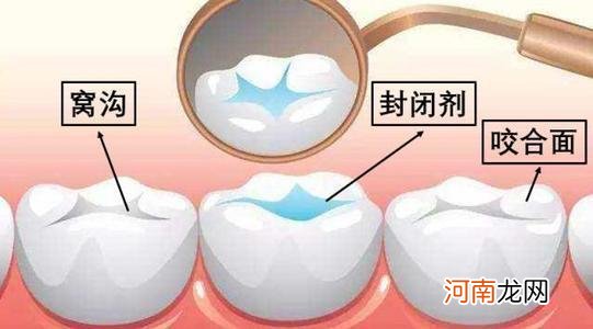 小孩子天天刷牙，怎么还有蛀牙？别急，口腔医生给你说说