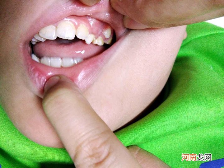6岁孩子长出双排牙，医生询问原因后才得知：都是精细喂养惹的祸