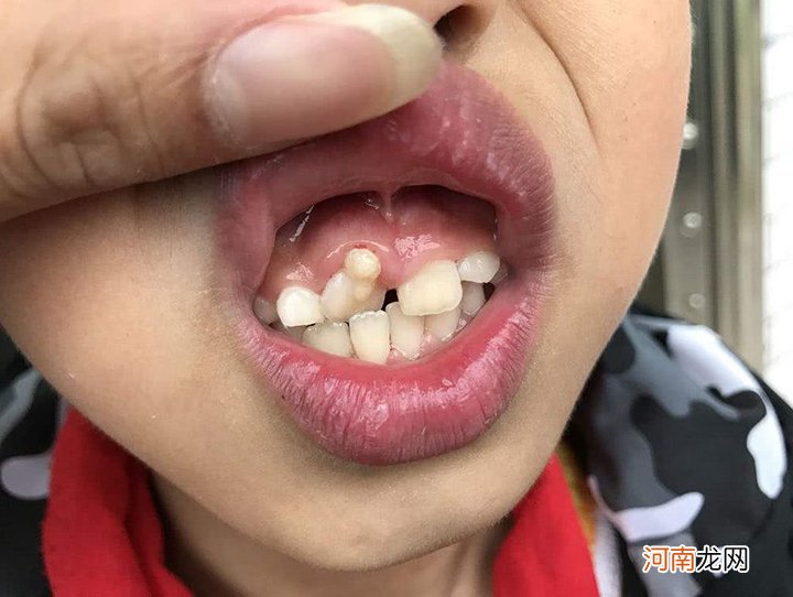 6岁孩子长出双排牙，医生询问原因后才得知：都是精细喂养惹的祸
