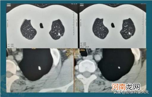 肺结核多久才是晚期 得了肺结核晚期,是不是没得医?