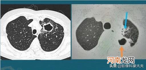 肺结核多久才是晚期 得了肺结核晚期,是不是没得医?