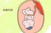 双子宫双阴道 双子宫双阴容易早产吗